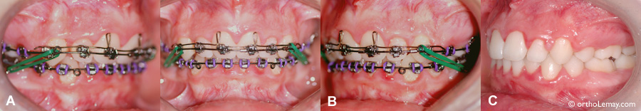 Begg torque auxiliary, orthodontie orthodontics 