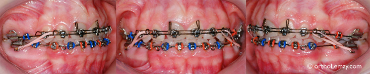 Begg torque auxiliary, orthodontie orthodontics 