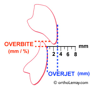 Définition de Overbite et overjet pour décrire une malocclusion dentaire en orthodontie. orthodontiste Sherbrooke Lemay