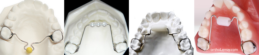 https://www.orthodontisteenligne.com/wp-content/uploads/2009/09/Bluegrass-appliance-perle-de-tucat-orthodontie.jpg