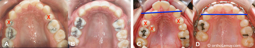 Contact etnre canines et molaires suite à des extractinos et un traitemenContact entre canines et molaires suite à des extractions  et un traitement d'orthodontie  d'orthodontie 