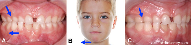 Occlusion croisee posterieure avec deviation mandibulaire