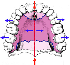 Suture maxillaire palatine et expansion orthodontique