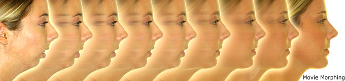 Doplhin imgaing system  logiciel de simulation orthodontique