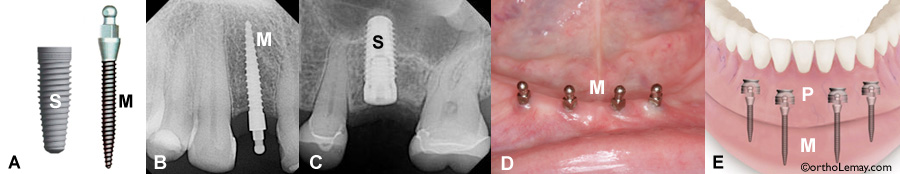 mini implant dentaire comparé à un implant dentaire régulier pour le support de prothèses dentaires