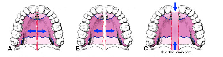L'ouverture de la suture maxillaire pendant l'expansion rapide