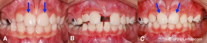 Déplacement des dents lors de la récidive de l'expansion maxillaire