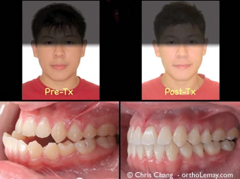 Severe class III case treated by Chris Chang. Sévère classe III traitée sans chirurgie