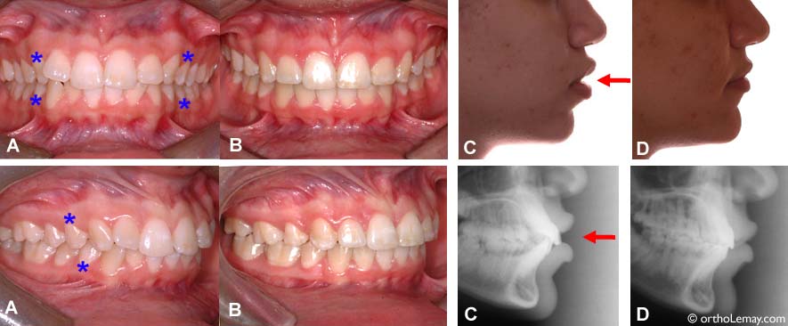 Extractions et l'influence sur le profil en orthodontie