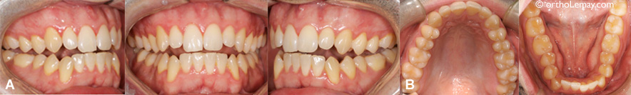 Béance antérieure, malocclusion dentaire