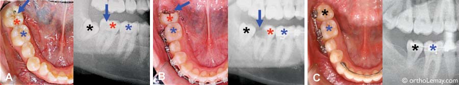 extraction dentaire pour traitement d'orthodontie d'une malocclusion