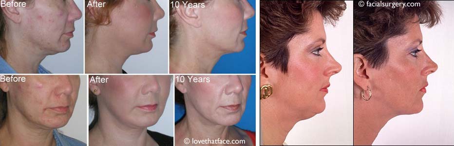 Lifting facial pour raffermir la peau du visage et éliminer un double menton.