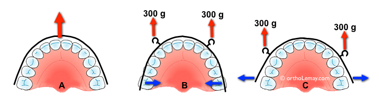 Position des crochets de traction sur l'arc maxillaire labial sur un appareil de traction extra-orale delaire et les effets sur les molaires