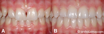 comment soigner espace entre les dents