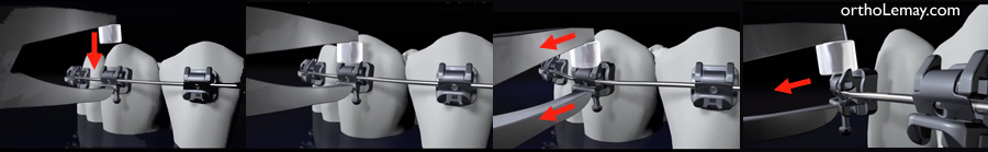 Enlèvement des boîtiers orthodontiques, brackets et appareils dentaires à l'aide de pinces et instruments orthodontiques 