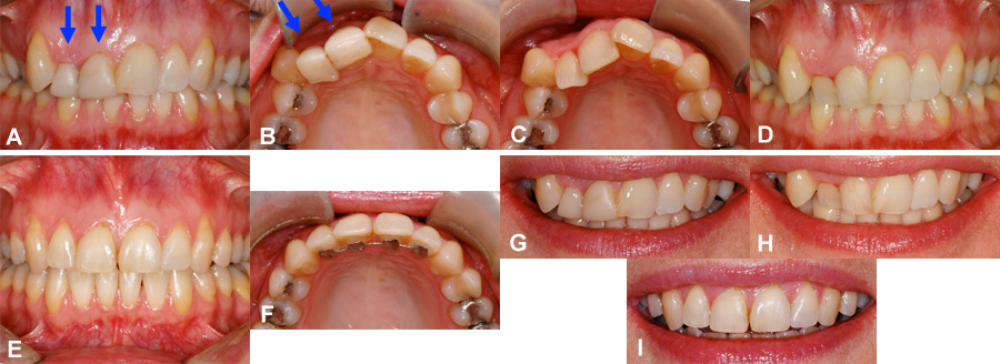 comment avoir des dents droites