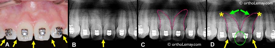 (A) Espaces inter-dentaires (embrasures) en "V" entre des incisives supérieures de forme ovale(flèches). (B) Radiographie montrant la forme des dents et l'espace entre les dents. (C) Même radiographie qu'en (B) avec le profil des racines des incisives centrales tracé en rouge. Ces racines sont plus courbées que la normale. (D) simulation d'un mouvement de bascule des couronnes des centrales vers le centre pour créer un meilleur contact et diminuer l'espace en "V" (cercle vert). L'effet secondaire de ce mouvement est qu'un espace plus grand apparaît entre les centrales et les latérales (flèches jaunes) et que les racines sont basculées vers celles des latérales (flèches vertes) et entrent en collision avec elles (* jaunes). Ce type de mouvement n'es pas recommandé à cause du dommage qu'il peut causer aux racines des dents. 
