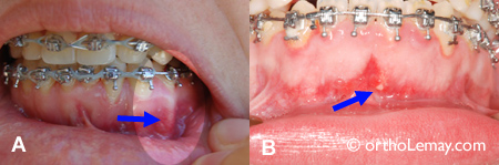Racine proéminente et trop basculée en orthodontie 