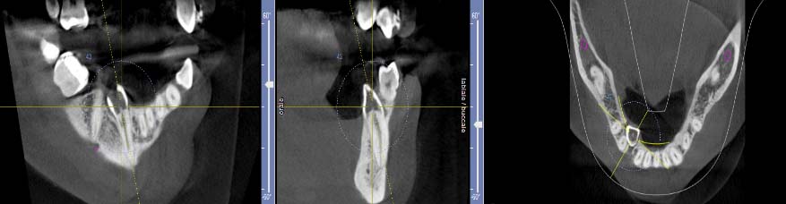 CBCT Cone Beam Computer Tomography (CBCT) tomodensitométrie volumique à faisceau conique (TVFC) d'une racine incluse ayant été fracturée lors de l'extraction 