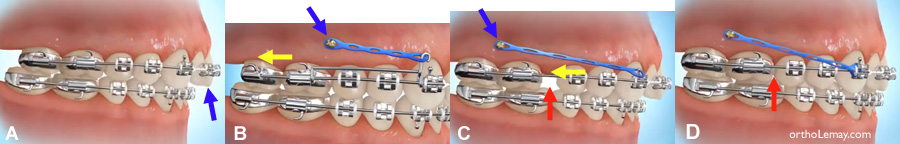 Mouvement dentaire avec mini-vis d'ancrage en orthodontie