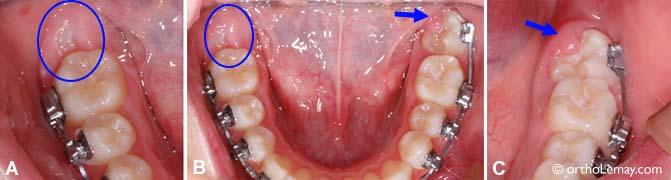 comment soulager la douleur d'une dent de sagesse qui pousse