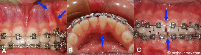 Exemples de problèmes et urgences orthodontiques.