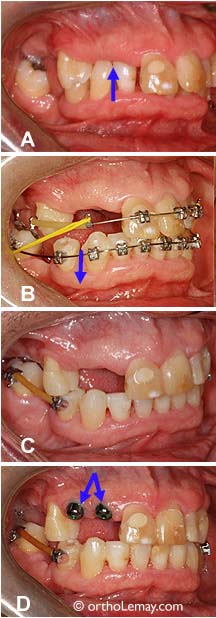 Restauration de la dimension verticale en orthodontie pré prosthodontique.