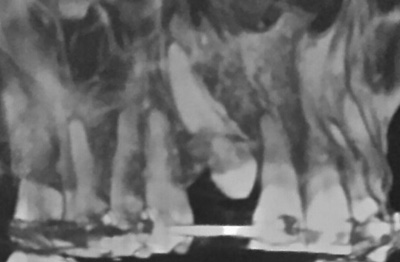 Canine incluse tomodensitométrie volumique à faisceau conique (TVFC) orthodontie. Impacted cuspid Cone Beam Computer Tomography (CBCT) orthodontics. 