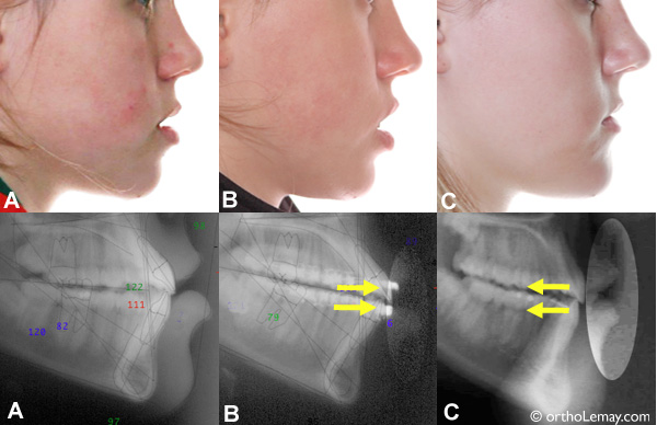 Influence des extractions sur le profil en orthodontie