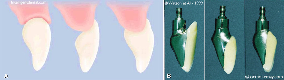 Design couronne dentaire sur pont et implant dentaire. 