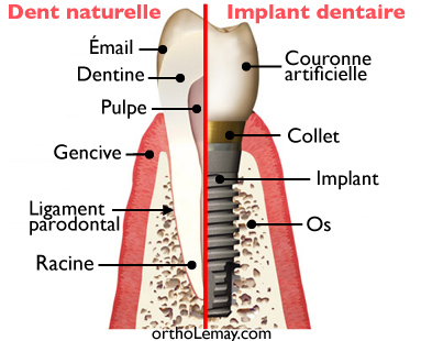 Comparaison entre une dent naturelle et un implant dentaire.