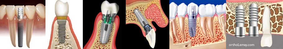 Position des imiplants dentaires dans l'os alvéolaire