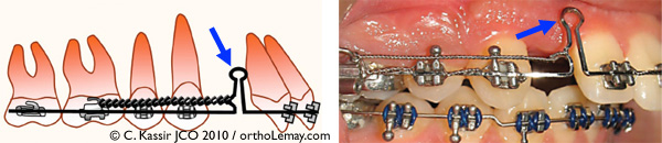 Boucle de étraction ou fermeture en orthodontie (closing loop)