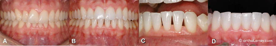 Fermeture d'espaces triangulaires noirs inesthétiques à l'aide de composite dentaire après un traitement d'orthodontie. 