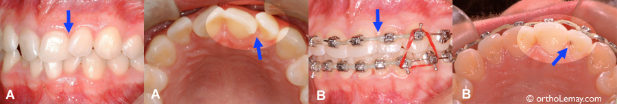 Rotation dentaire, malocclusion et carie dentaire. Correction en orthodontie.