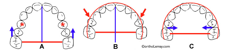 Influence des extractions sur la longueur et la forme de l'arcade dentaire. 