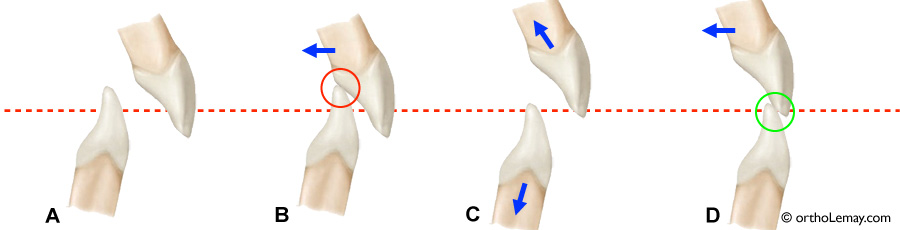 Ouverture de l'occlusion (bite opening) par intrusion des incisives en orthodontie