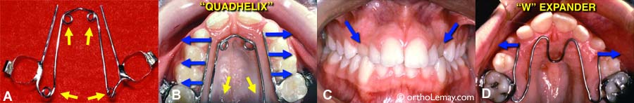 expansion dentaire à l'aide d'un appareil W expander et quad helix