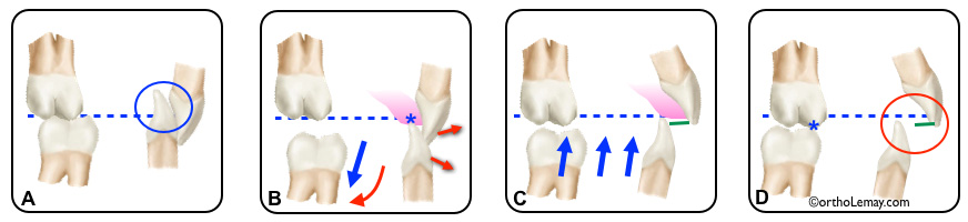 plan articulé ou bite plane utilisé en orthodontie pour ouvrir l'occlusion