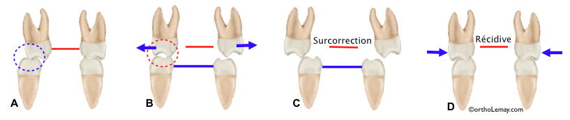 Surcorrection et interférences dentaires pendant l'expansion maxillaire rapide en orthodontie