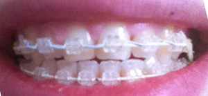 malocclusion dentaire béance antérieure traitement d'orthodontie 