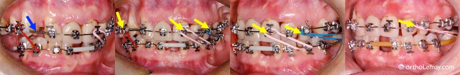 Correction de la ligne médiane en orthodontie 