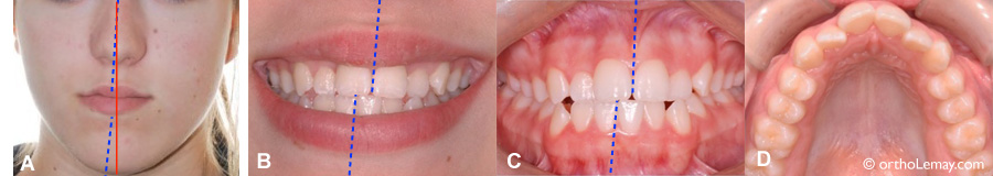 Lignes médianes dentaires et faciale non concordantes.