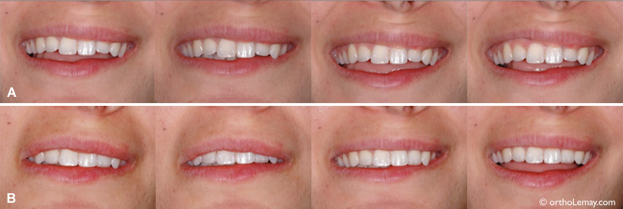 L'esthétique du sourire est affecté par la position des lèvres et le dégagement des dents. 