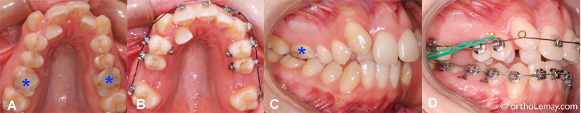 Extraction de molaires abimées pour un traitement d'orthodontie 