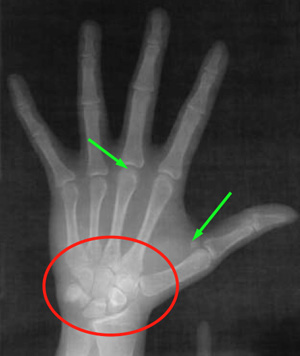 L'os sésamoïde du poignet et l'évaluation de la croissance squelettique