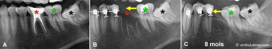 L'extraction d'une dent laisse une cavité qui se remplira d'os progressivement. 