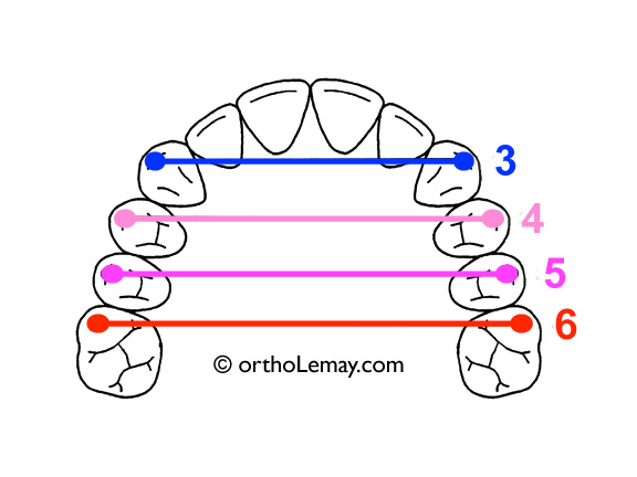 Les extractions de diminuent pas la largeur des arcades dentaires lors d'un traitement d'orthodontie.