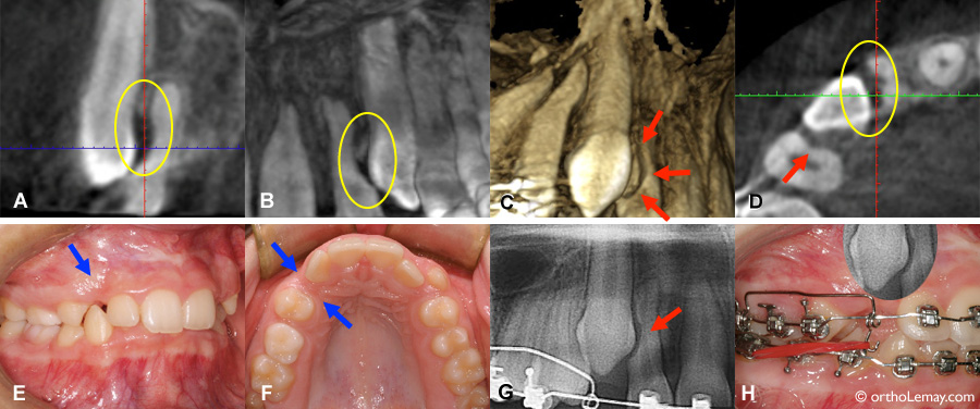 resorption laterale canine CBCT 113188 JB14