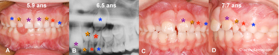 dent surnuméraire temporaire, orthodontie orthodontiste Sherbrooke  